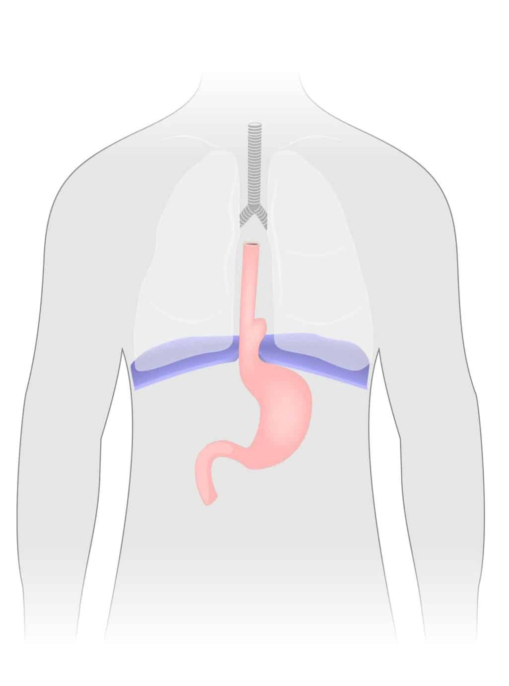 Hiatal hernia Zwerchfellbruch, axiale Gleithernie