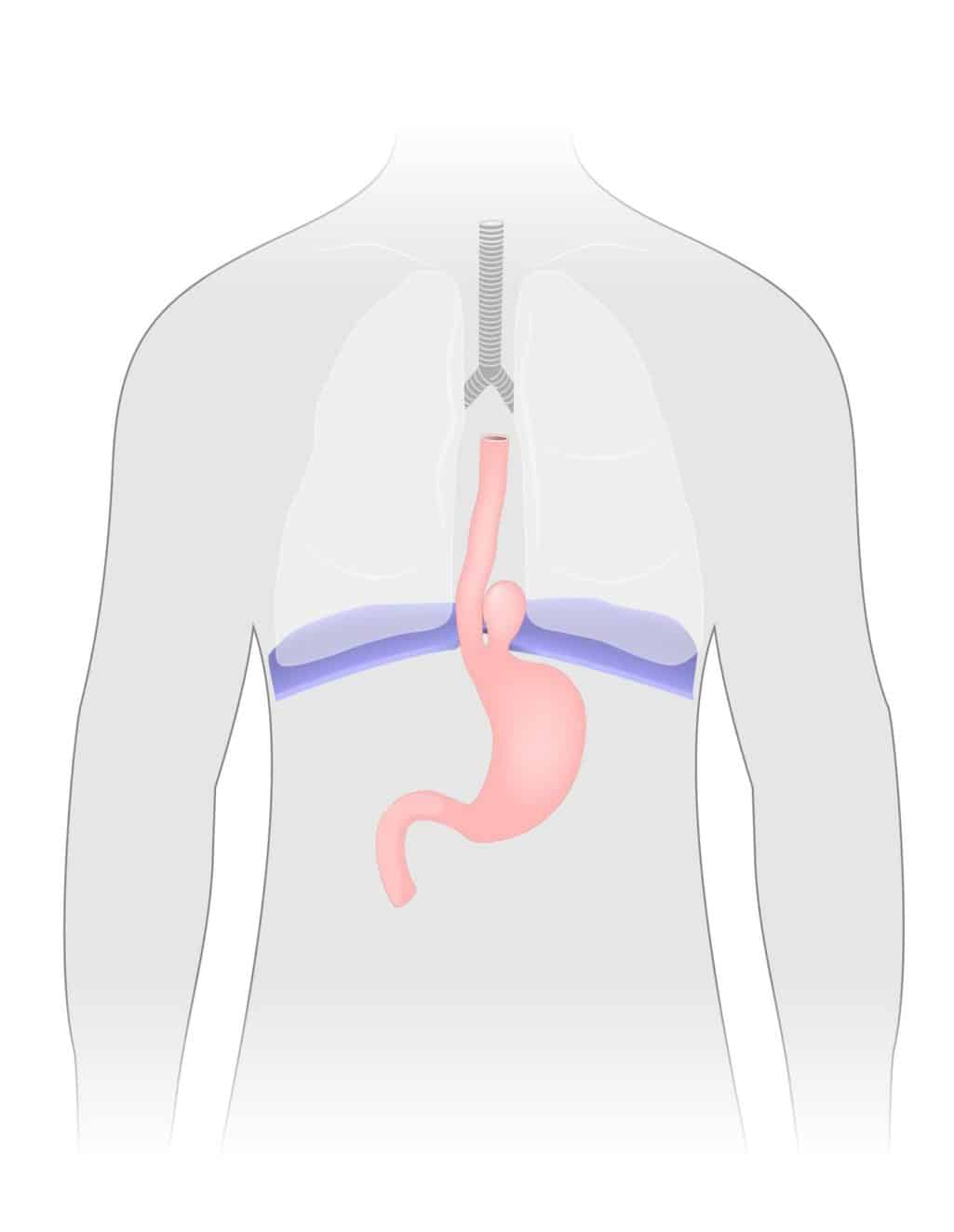 Hiatal hernia Zwerchfellbruch,paraösophageale Gleithernie