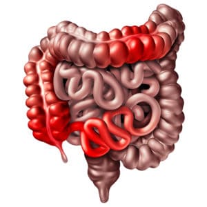 Morbus Crohn, typische Entzündungsbereiche