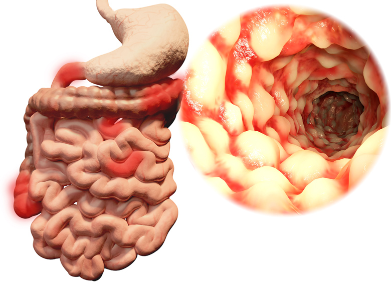 Morbus Crohn - Chronisch Entzündliche Darmerkrankung?