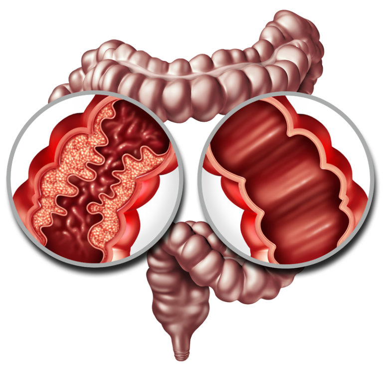 Morbus Crohn chronisch entzündliche Darmerkrankung?