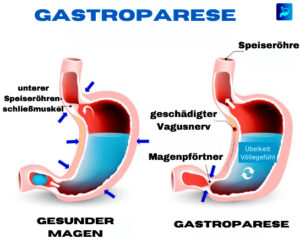 Gastroparese-Schema