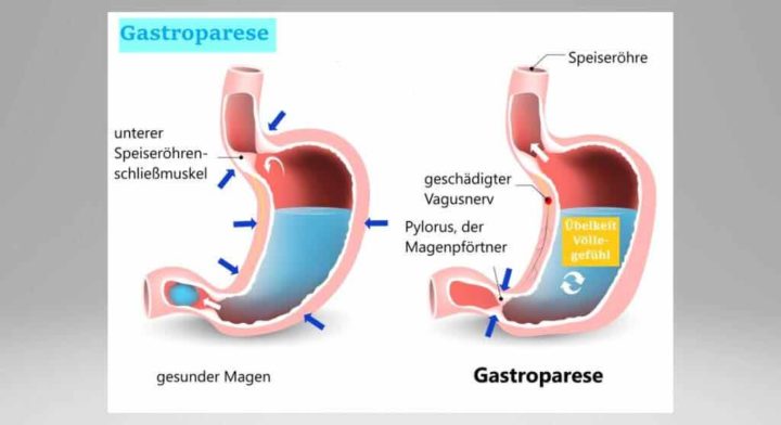 Magenklappe Schließt Nicht Richtig Was Tun magenkompass.de