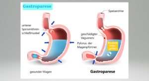 Gastroparese