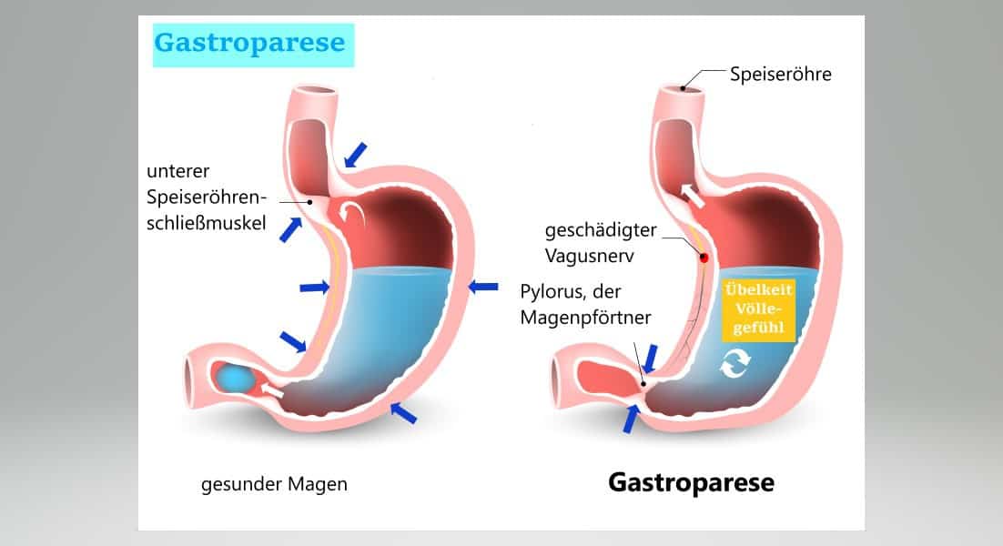 Wie kann man die Magenentleerung beschleunigen?