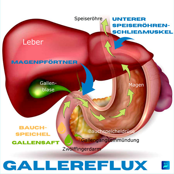 Gallereflux -Schema
