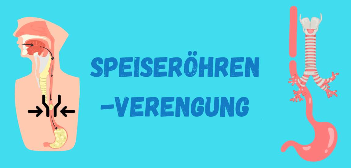 Speiseröhrenverengung Verengungen der Speiseröhre